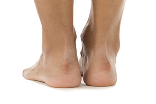 Risk Factors for a Bump on the Heel