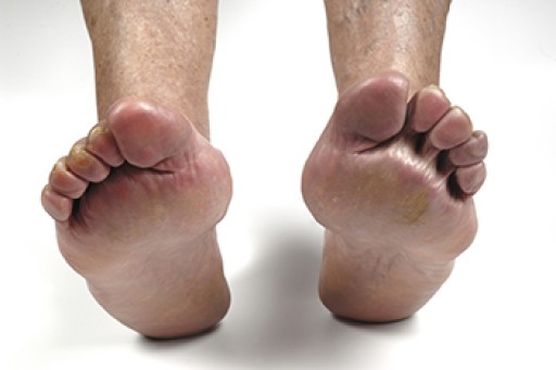 Rheumatoid Arthritis in the Feet