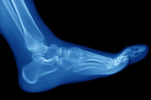 Stress Fractures of the Foot and Ankle