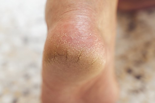 Cracked Heels and Their Connection to Various Conditions