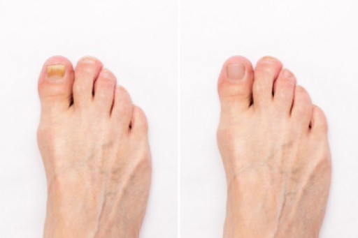 Treating Toenail Fungus